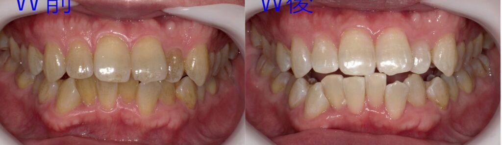 よねみつ歯科　ホワイトニング比較