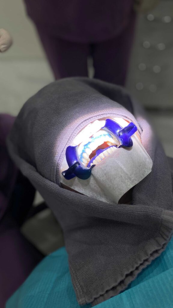 よねみつ歯科　六甲道　歯のクリーニング