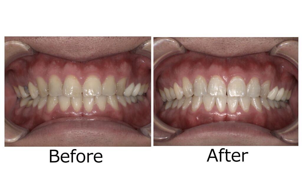 神戸 よねみつ歯科 ホワイトニング