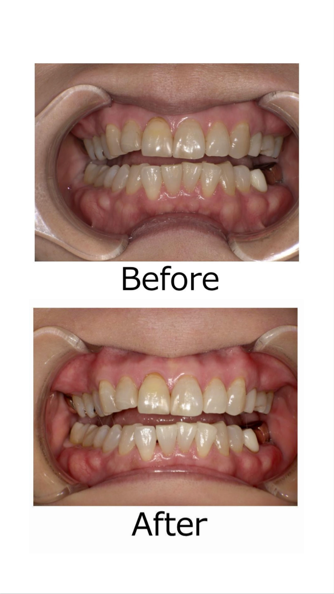 ホワイトニング